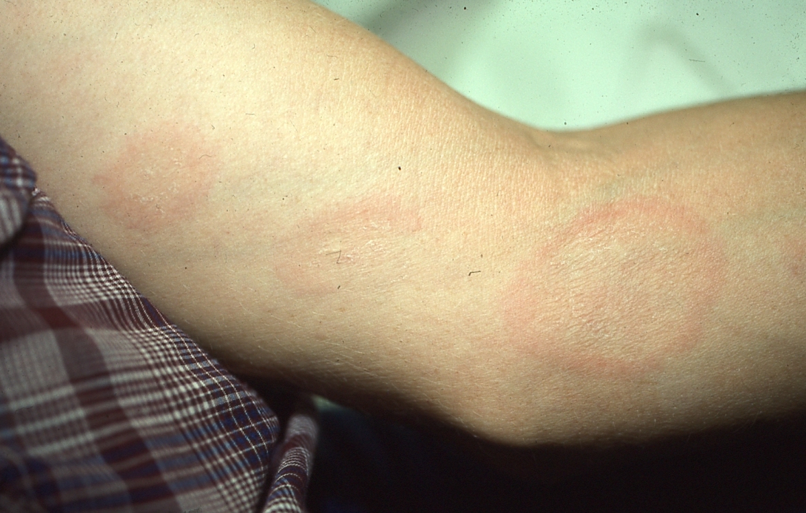 Erythema annulare centrifugum