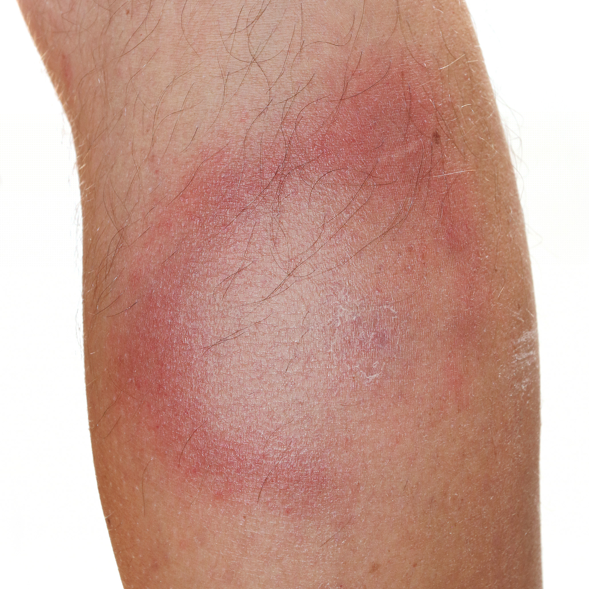 Erythema chronicum migrans