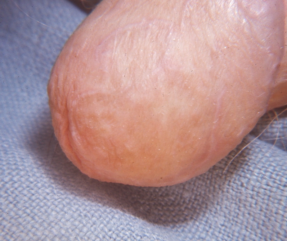 Lichen planus