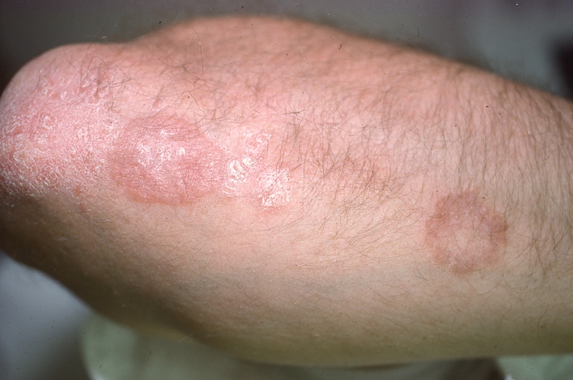 Psoriasis