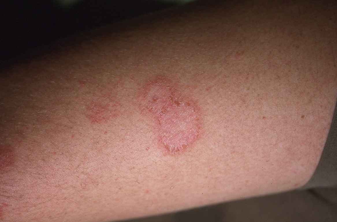 Nummular eczema