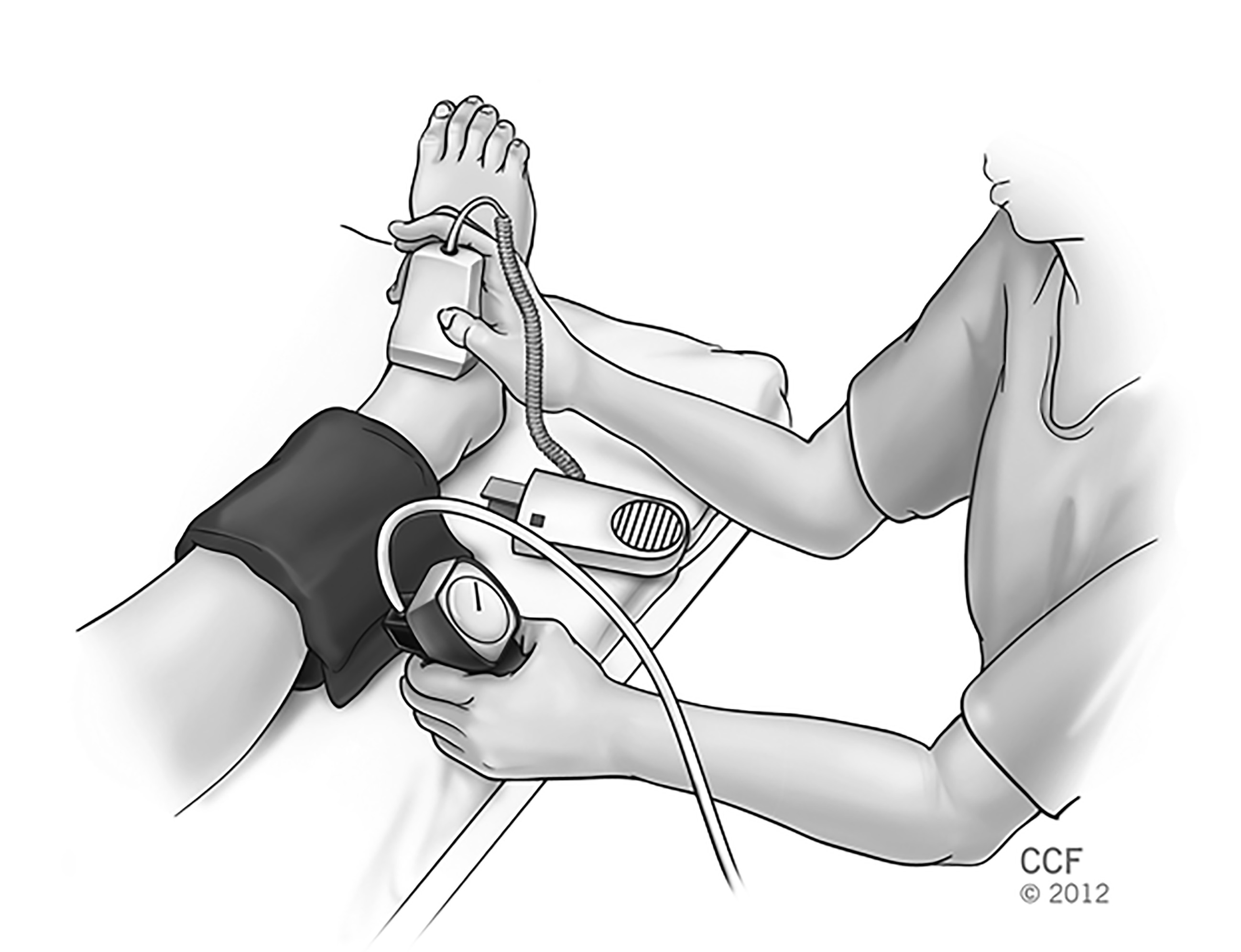Ankle-brachial index illustration