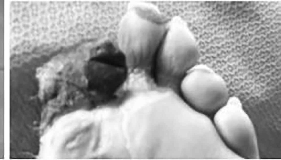 Dry gangrene of great toe