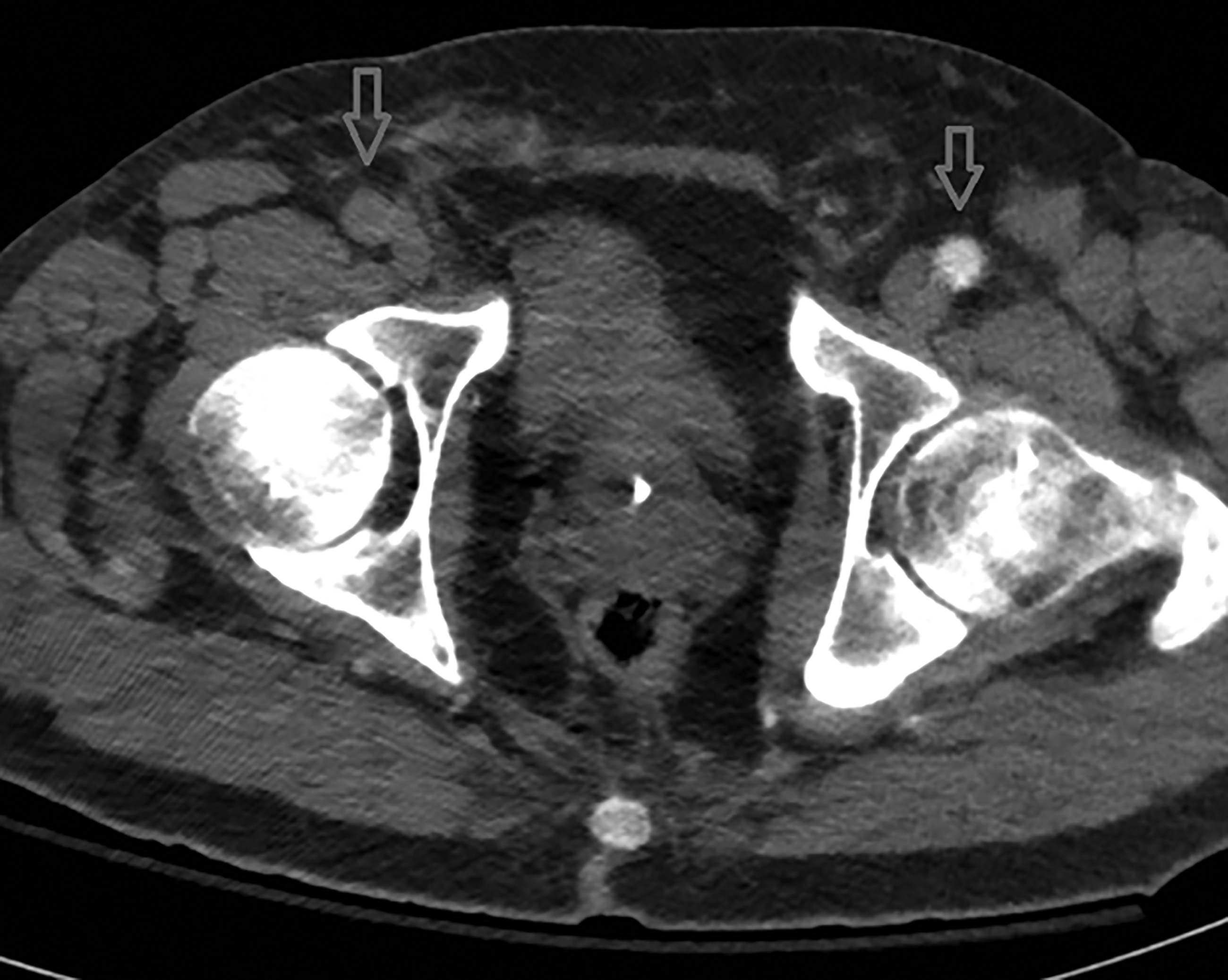 Common femoral artery occlusion