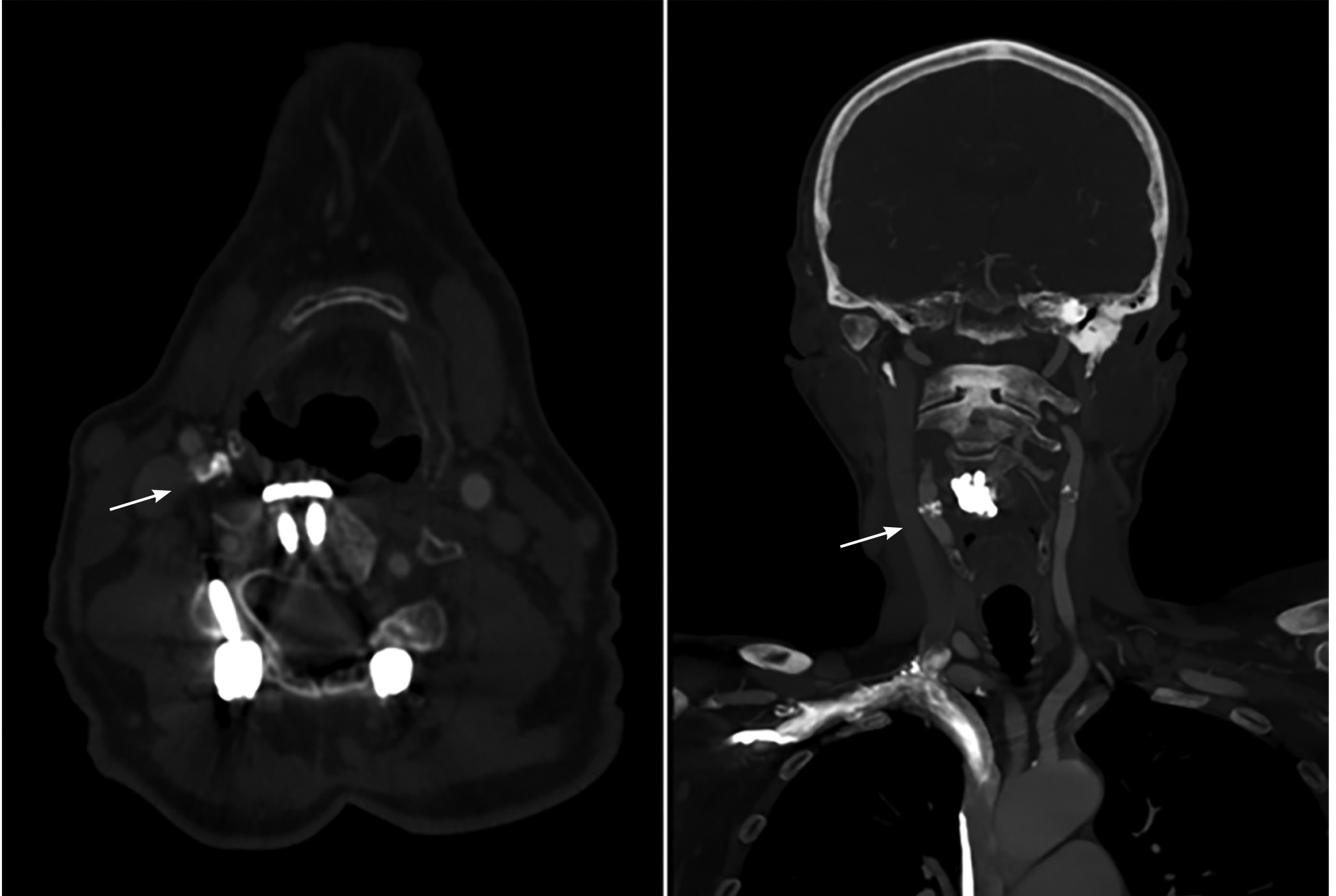 Right internal carotid artery stenosis