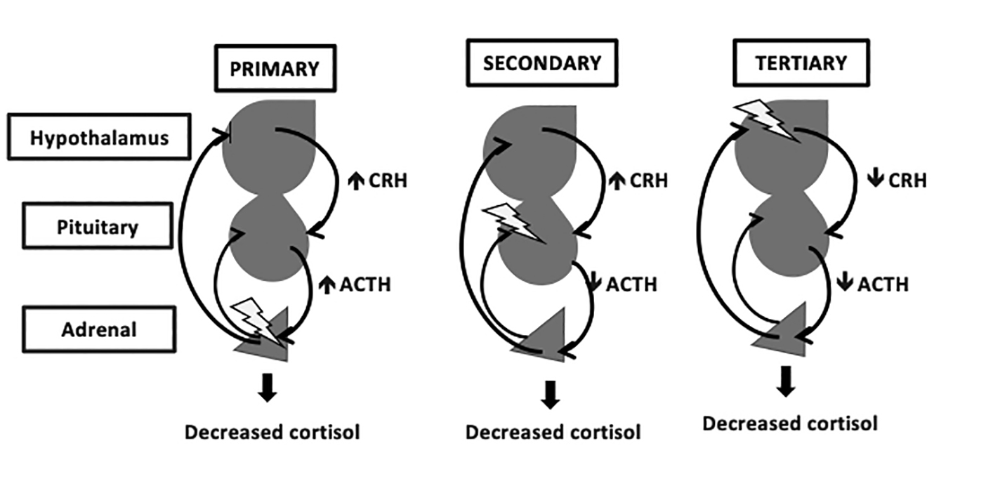 Primary, Secondary, and Tertiary Adrenal Insufficiency