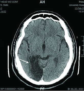 CT scan of the head