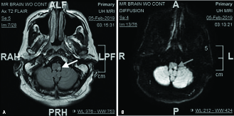 MRI brain