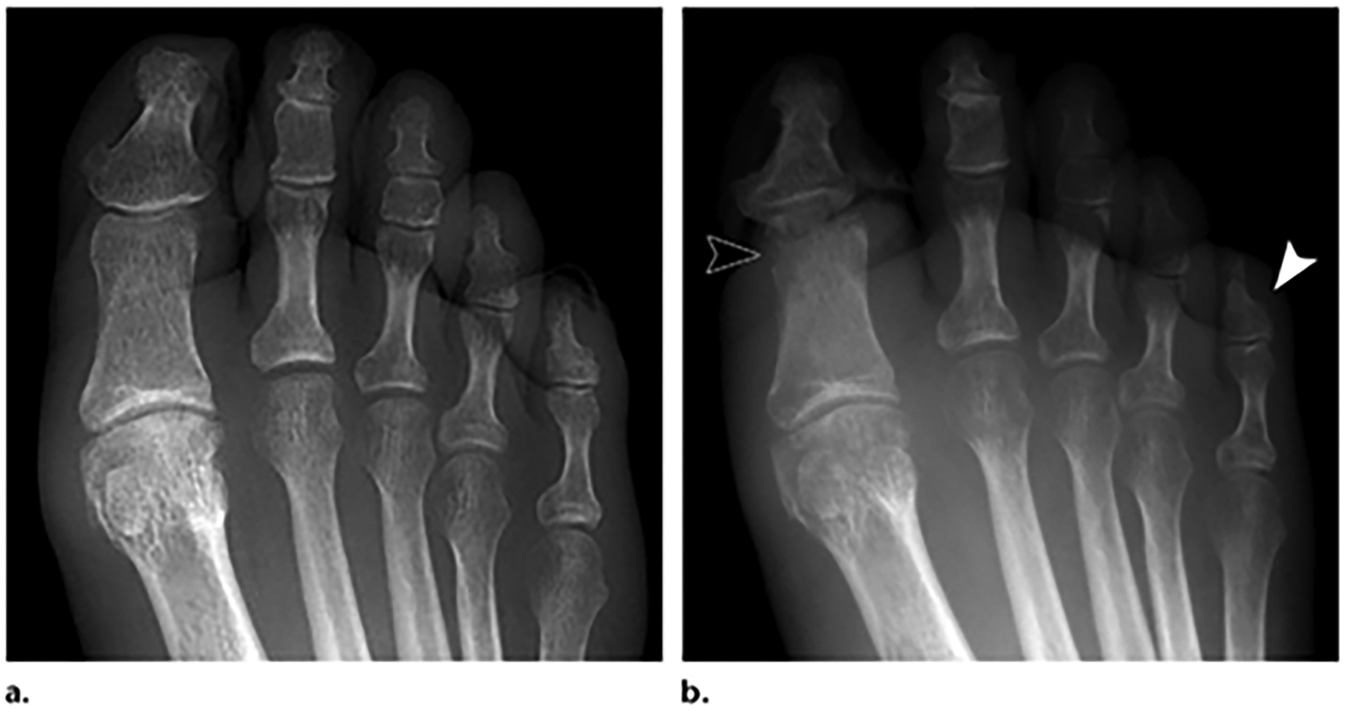Right toe frostbite