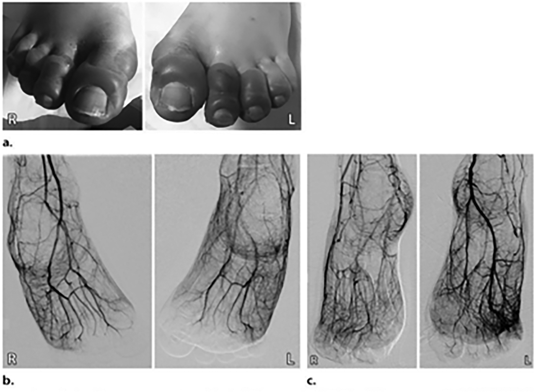 Third-degree frostbite