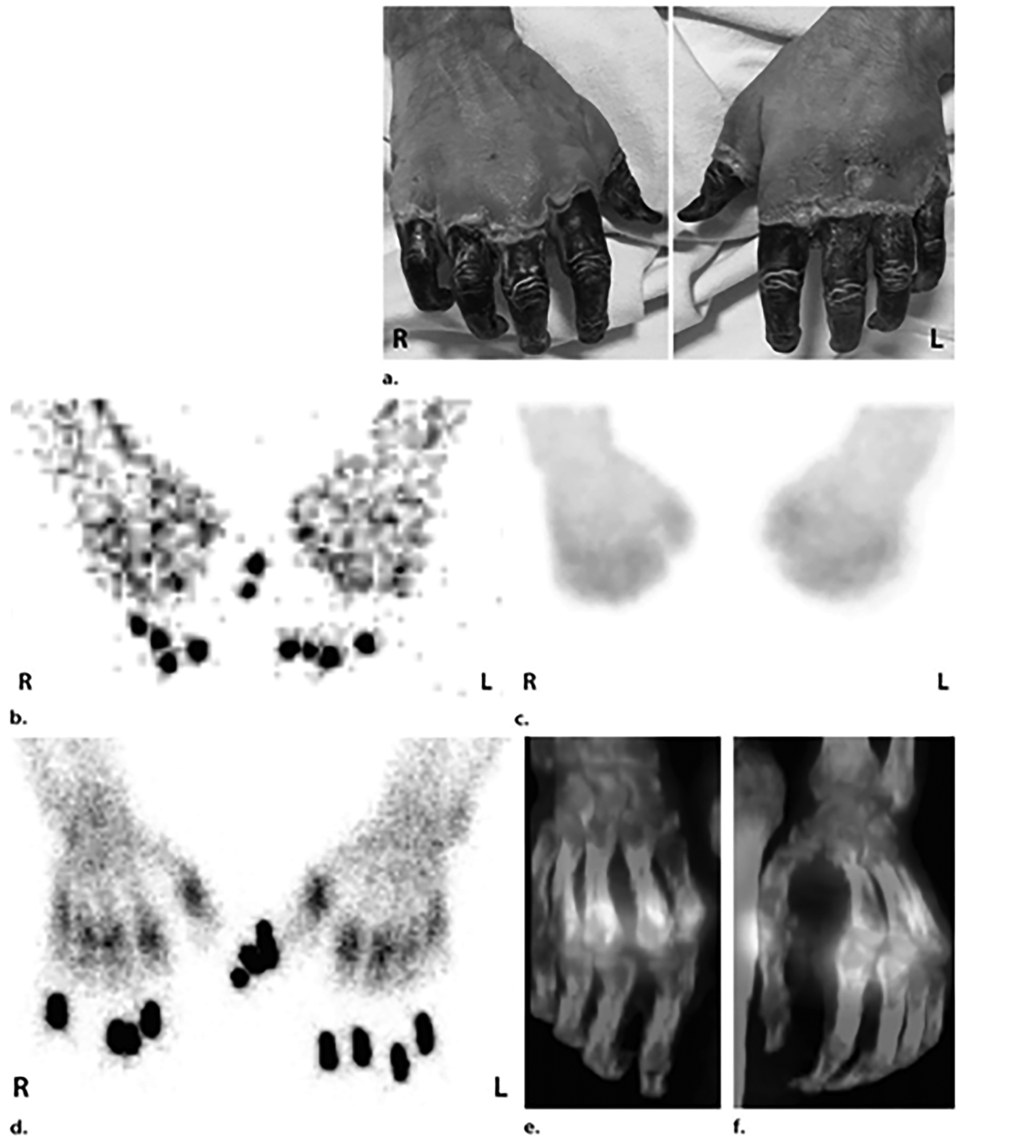 Fourth-degree frostbite