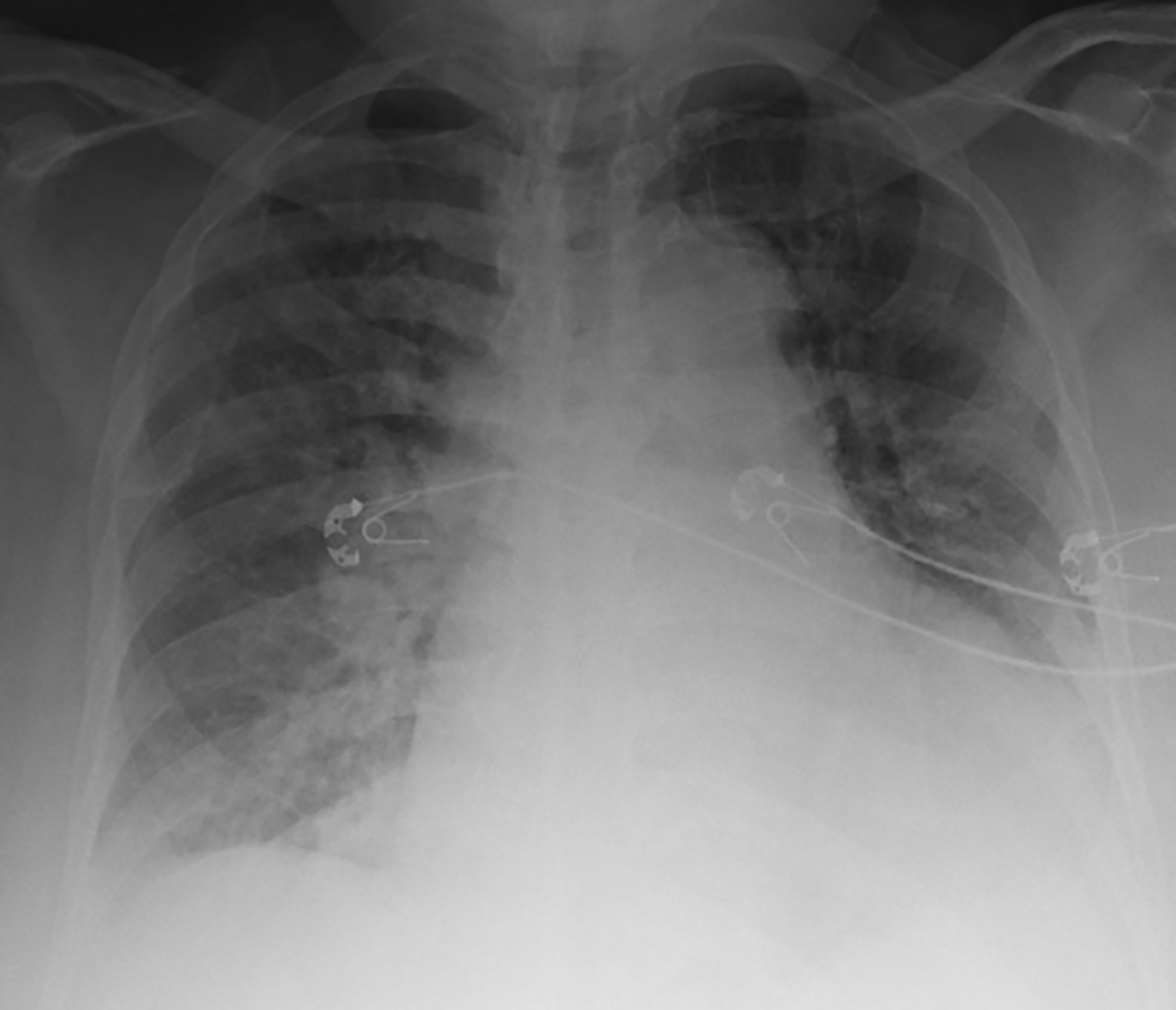 Chest X-ray