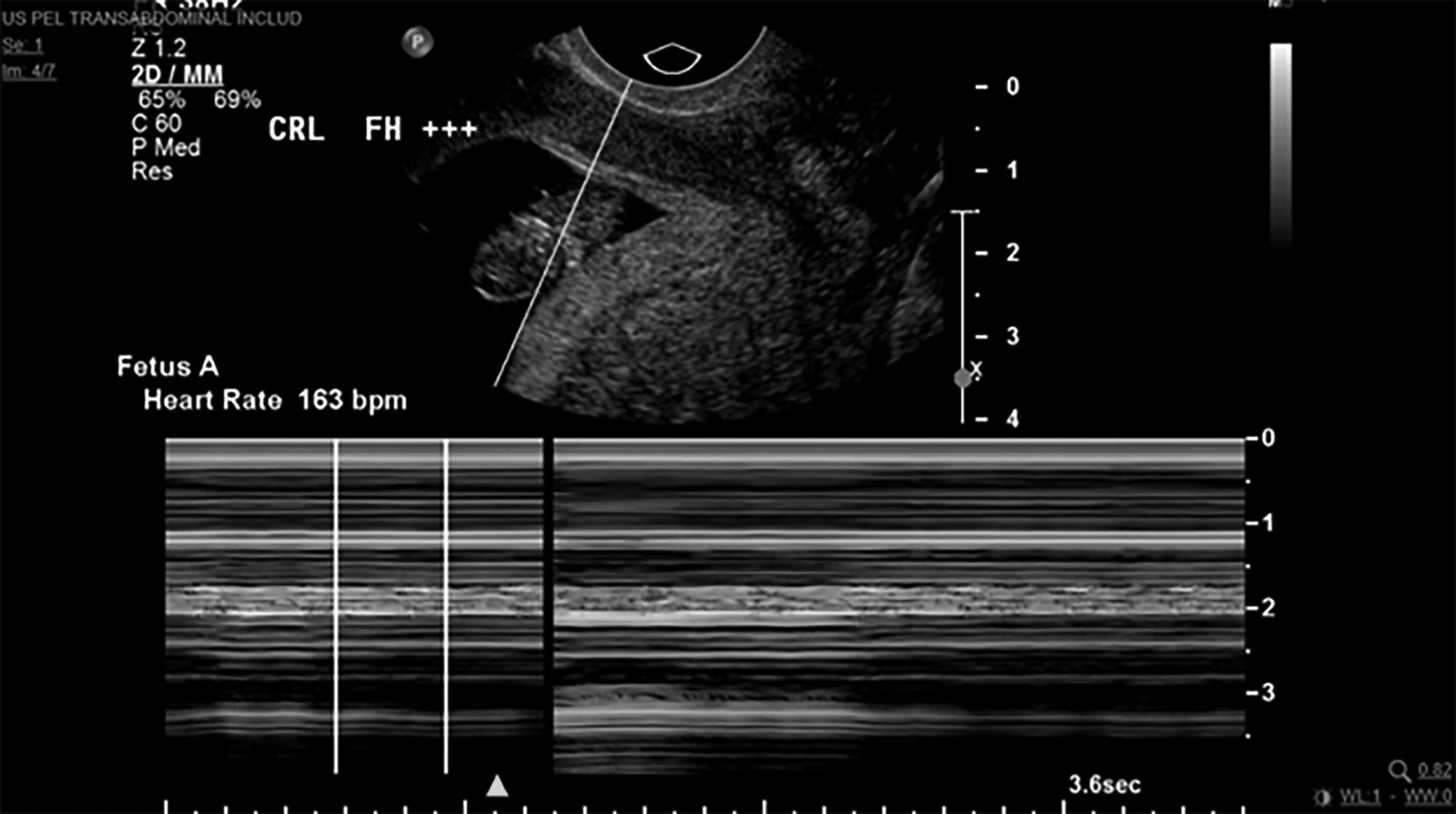 Intrauterine pregnancy