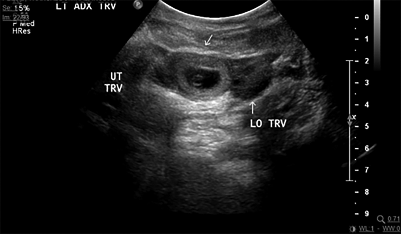 Ectopic pregnancy