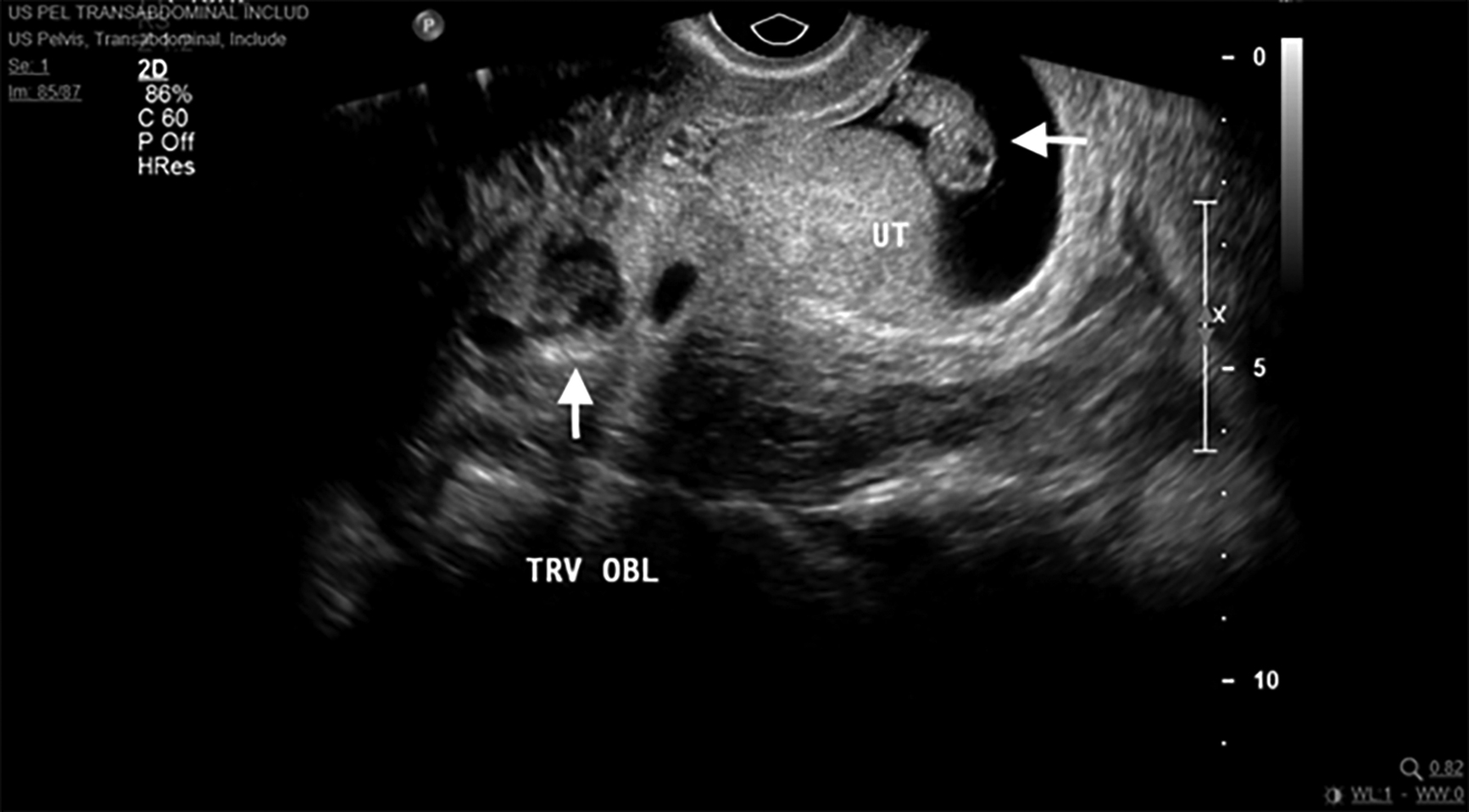 Heterotopic pregnancies