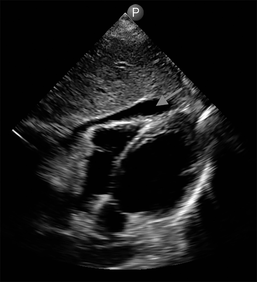 Point-of-care Echocardiogram