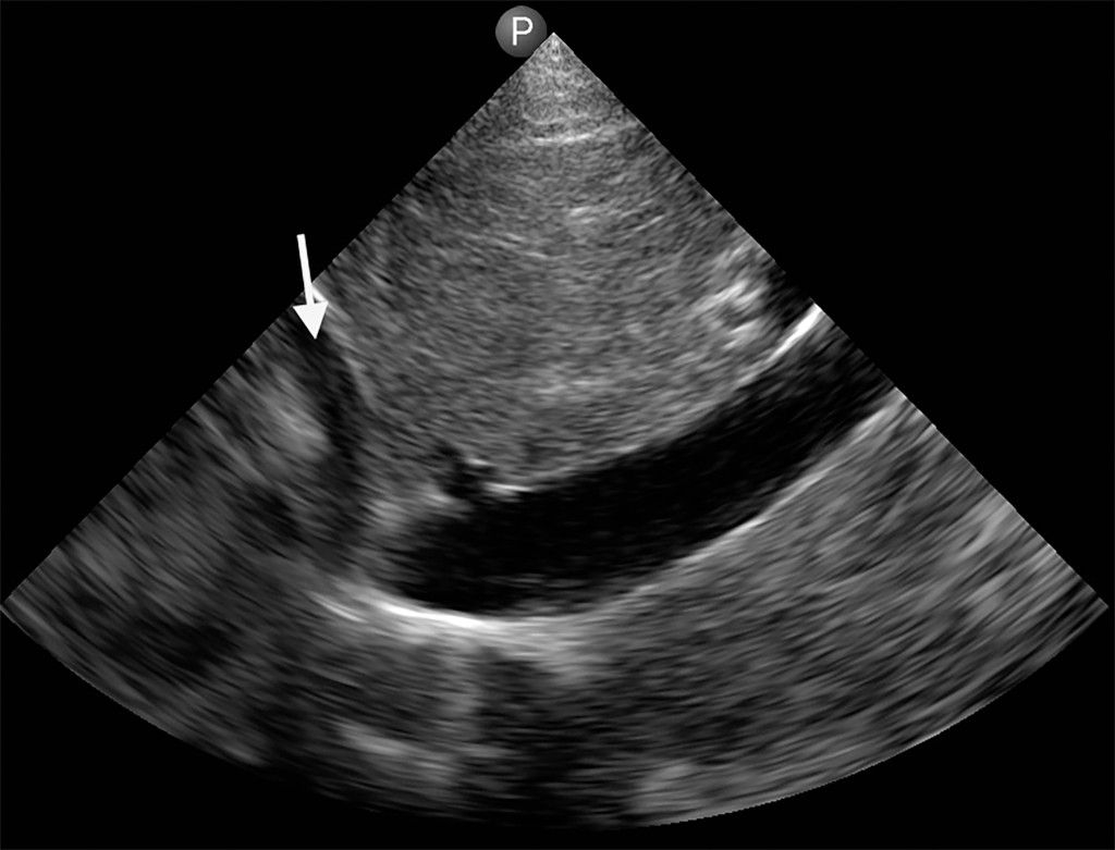 Point-of-care Echocardiogram