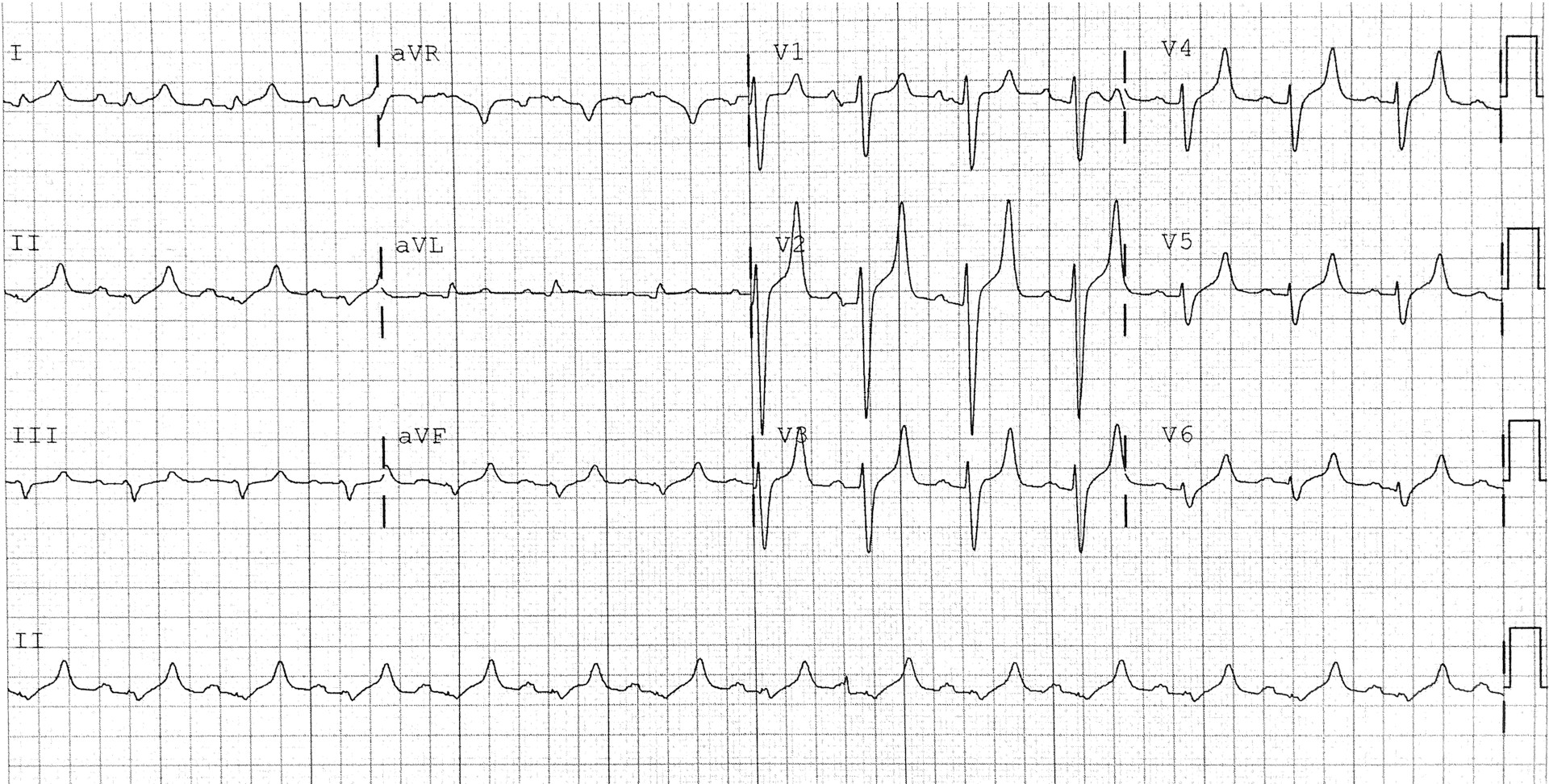 Electrocardiogram