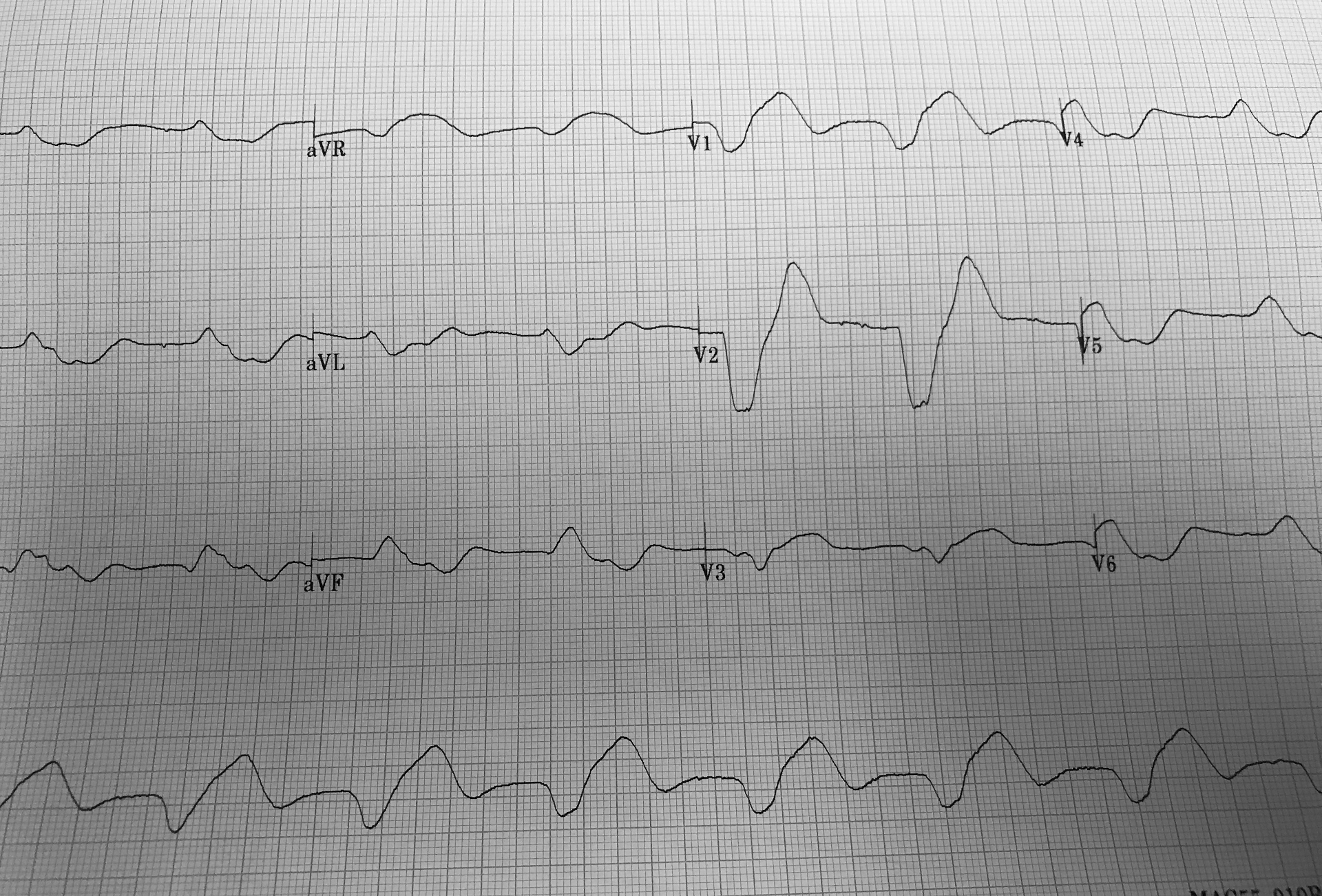Electrocardiogram with a sine wave