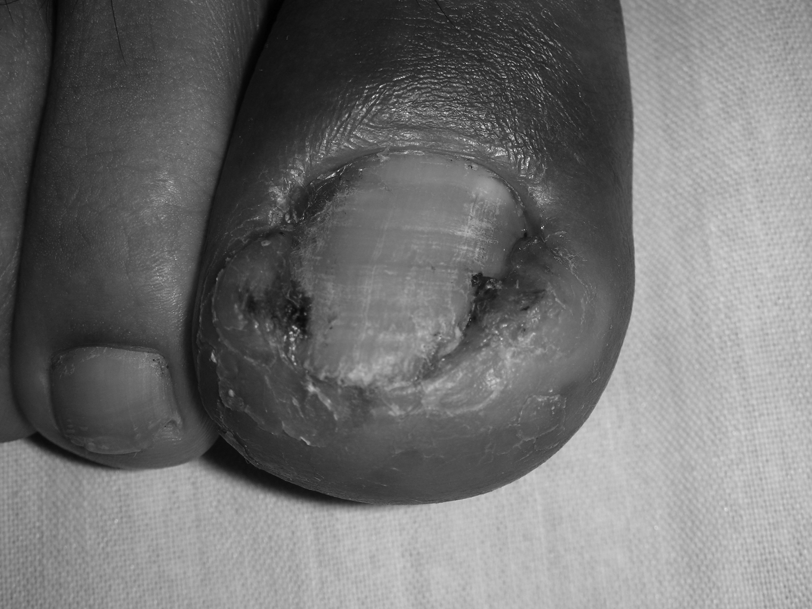 Ingrown toenail
