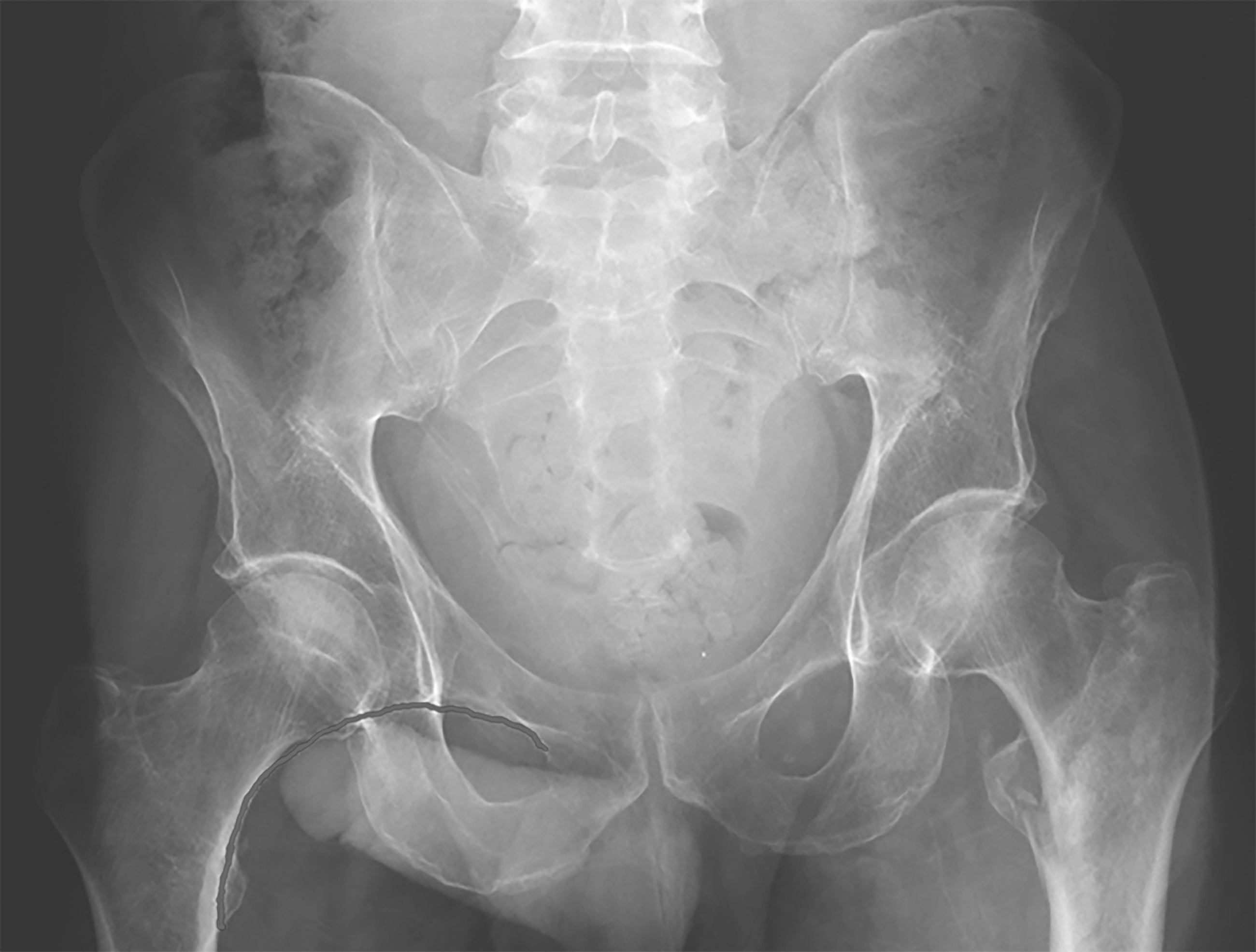 Intertrochanteric fracture