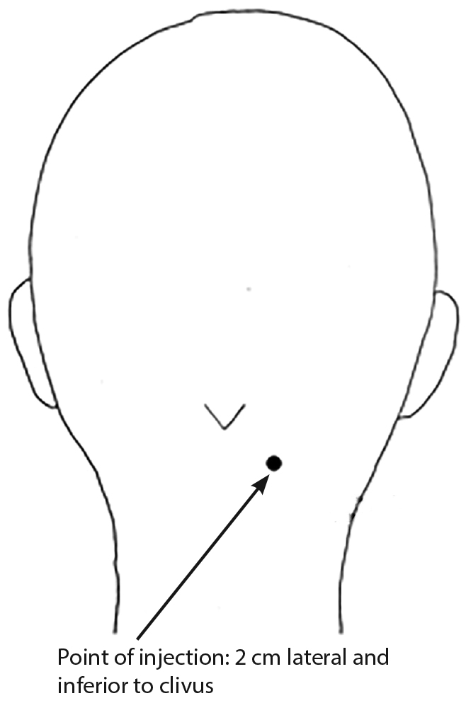 Greater occipital nerve block