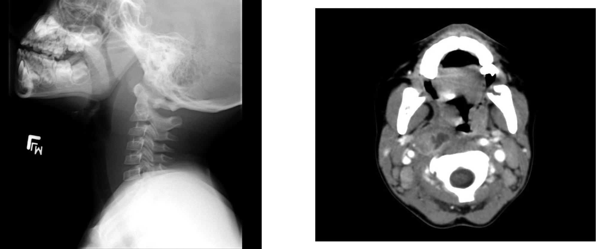 Retropharyngeal abscess