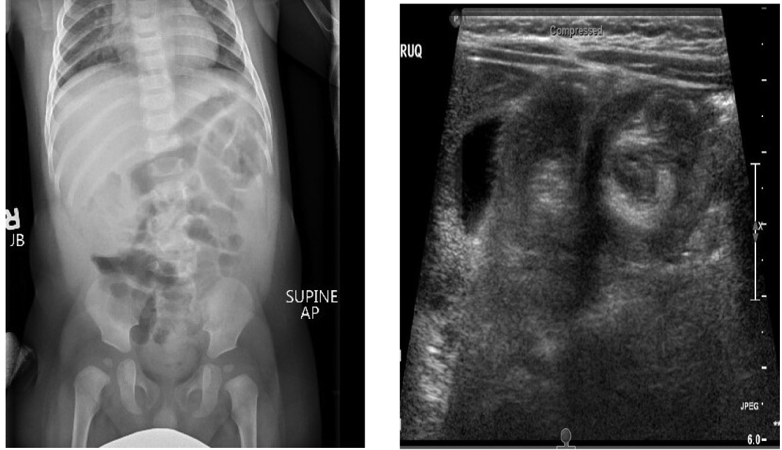 Intussusception