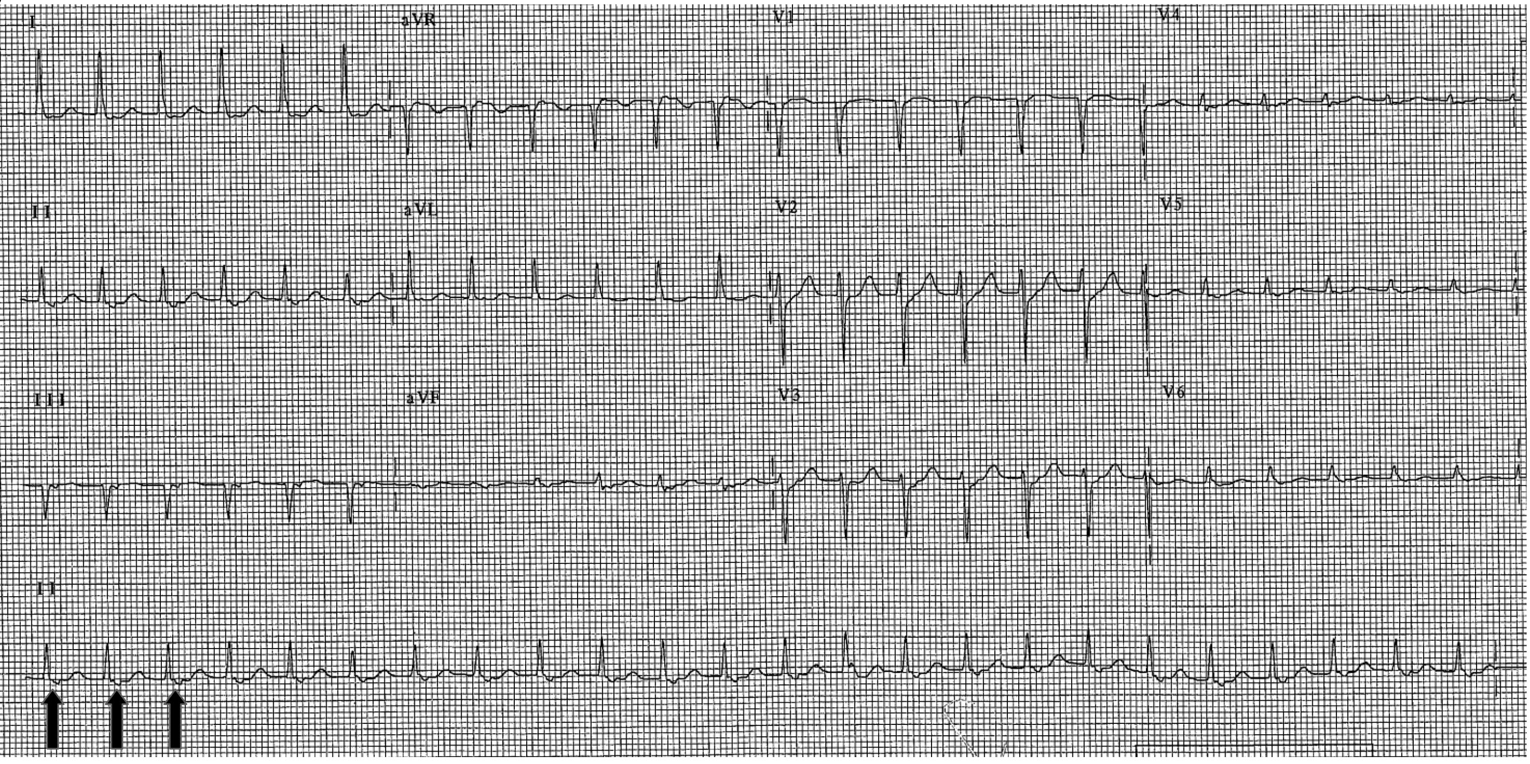 common type ECG