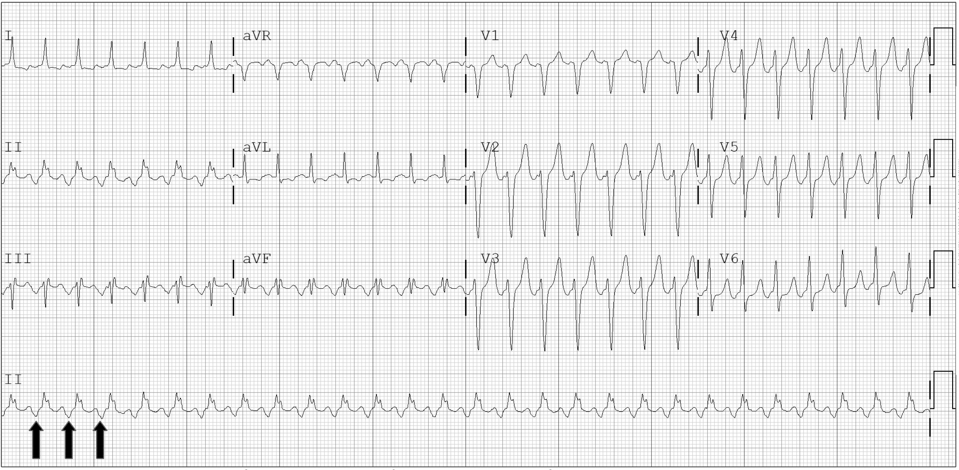 Uncommon type ECG