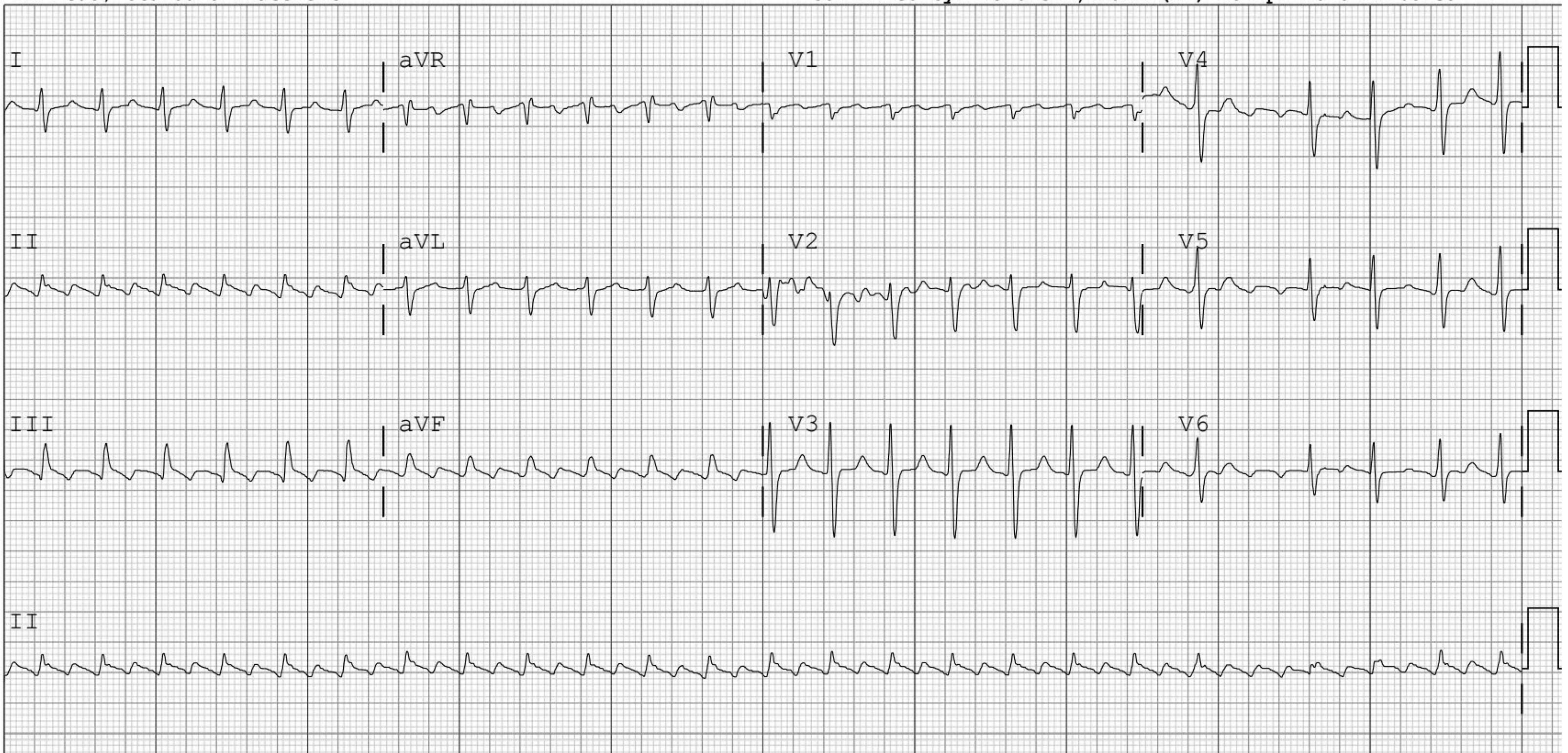 Atrial flutter with 2:1 AV block