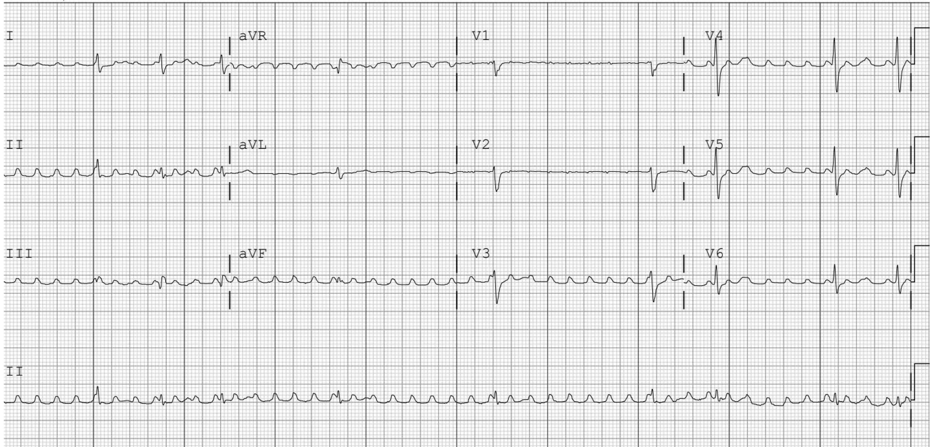 Atrial flutter with variable AV block