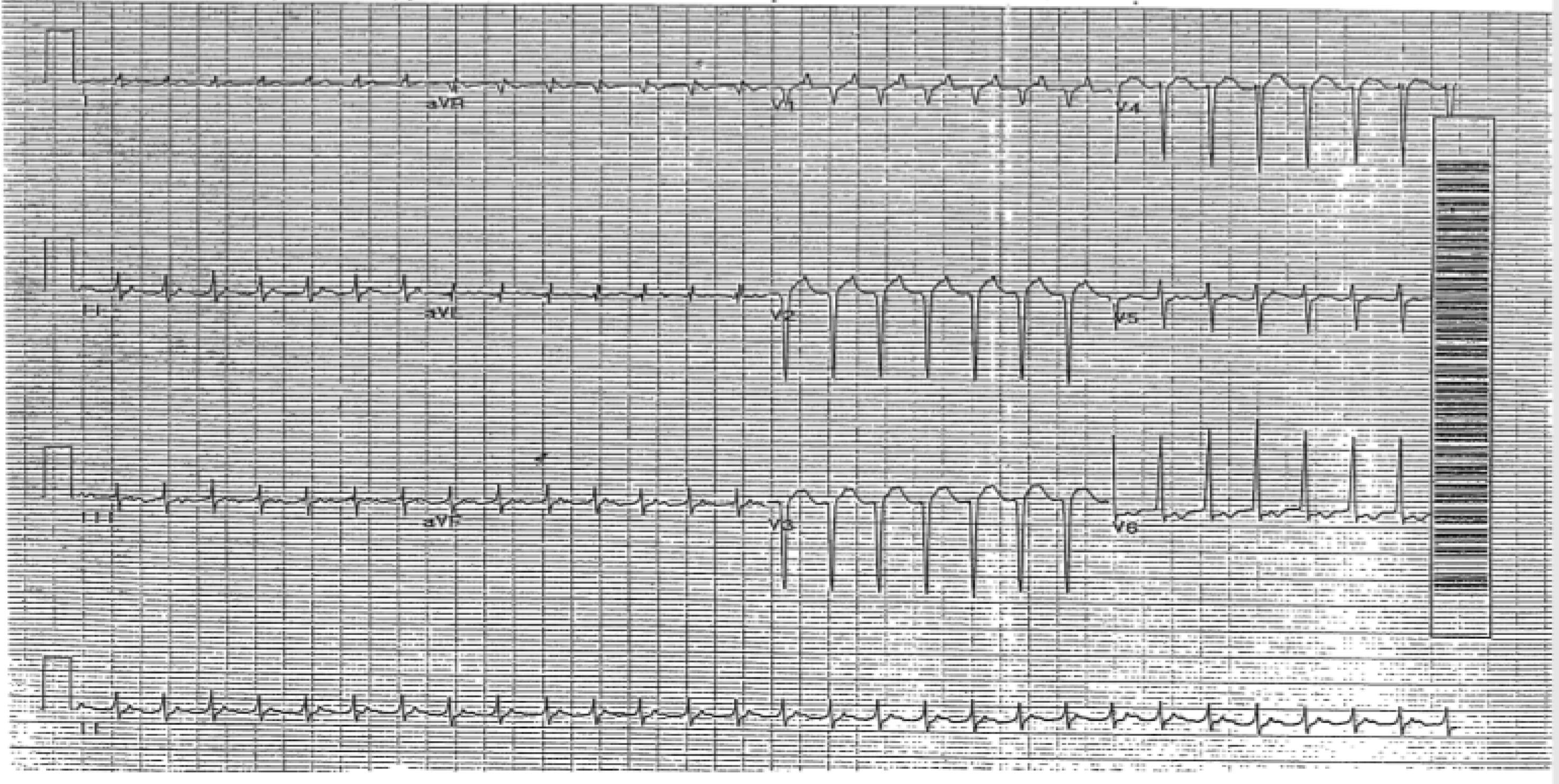 Atrial tachycardia