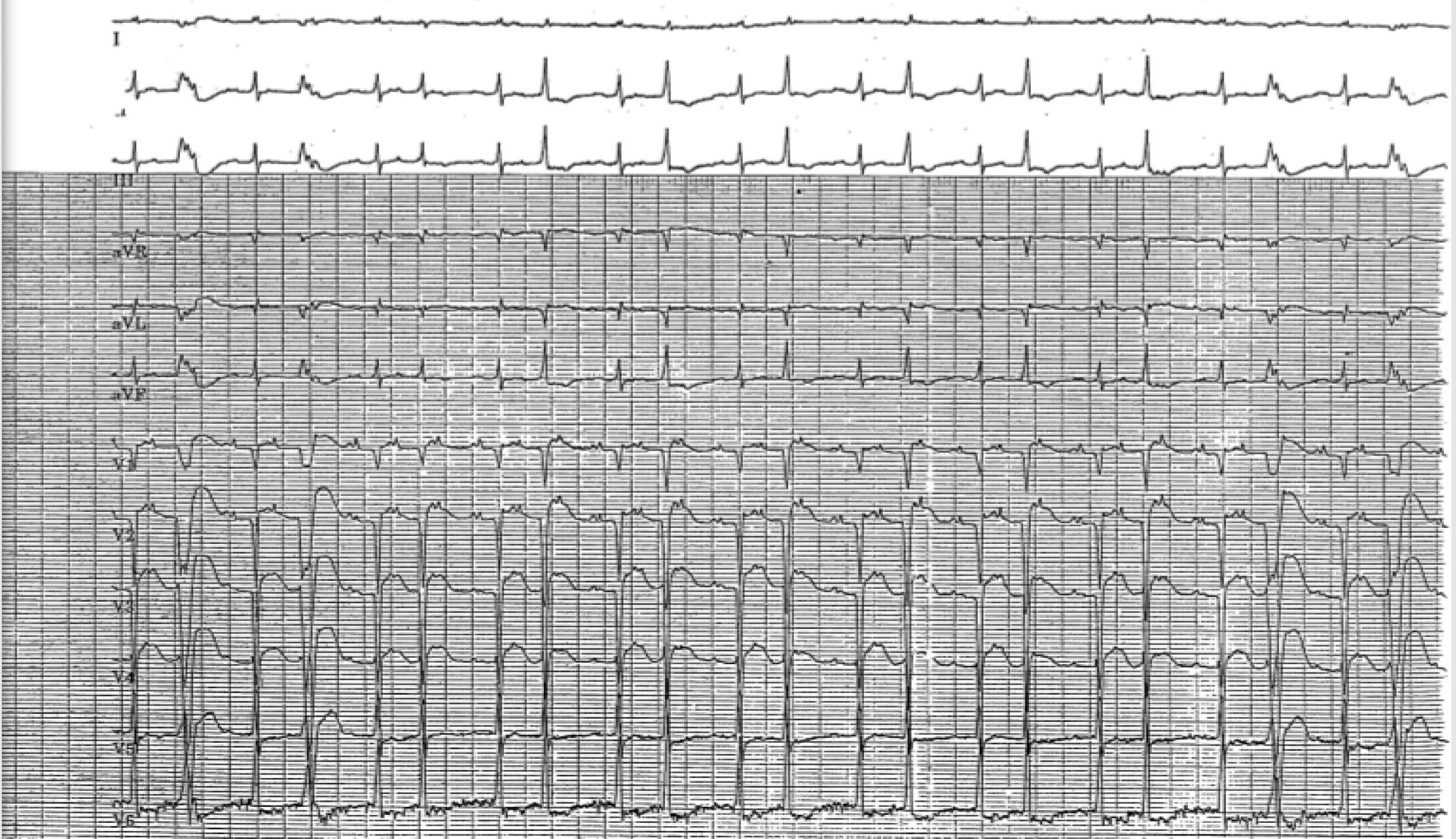Valsalva-inducing intermittent 2:1 AV block