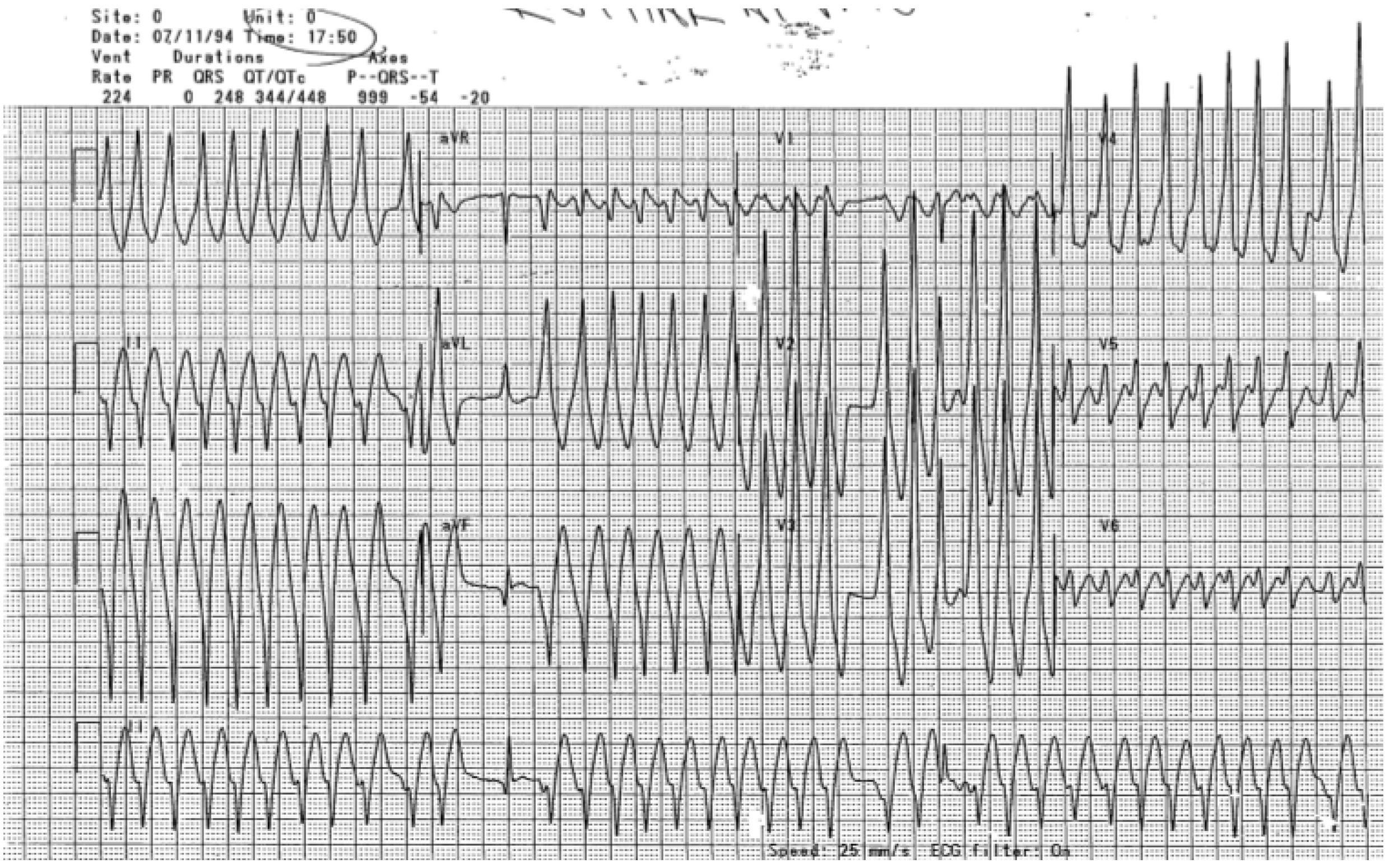 Wolff-Parkinson-White syndrome