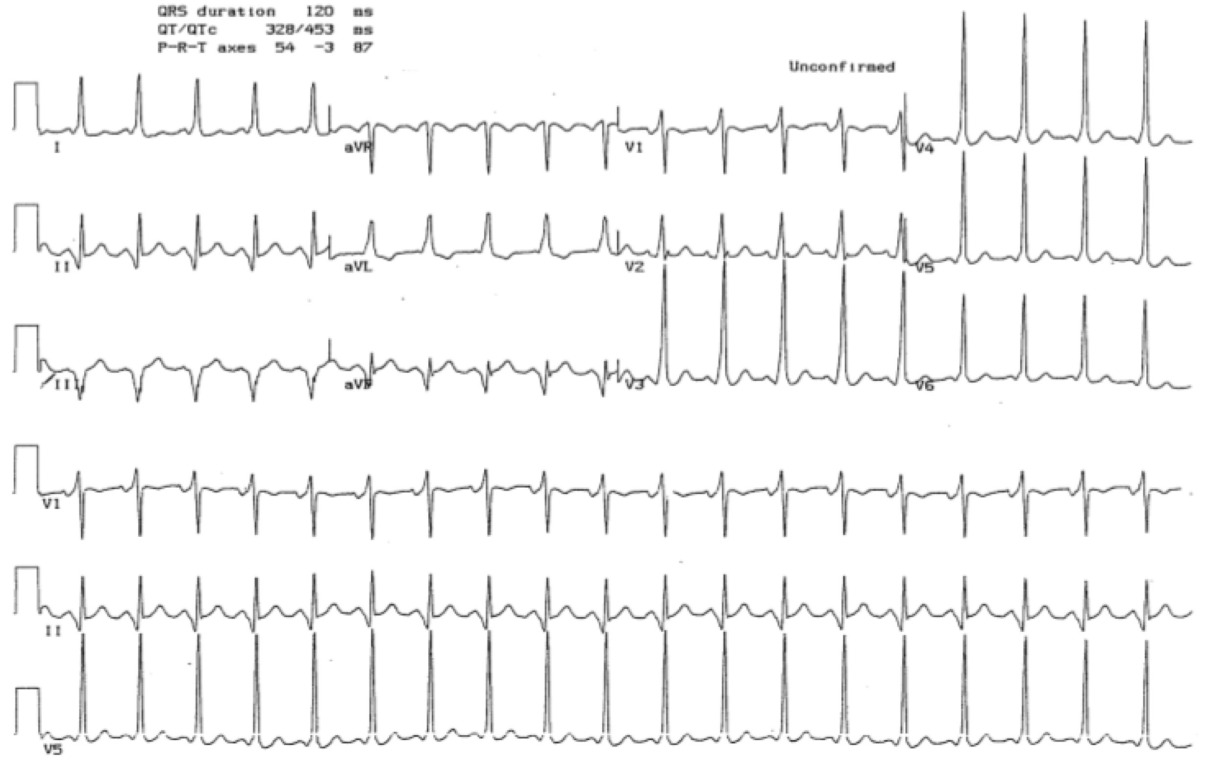 Wolff-Parkinson-White syndrome