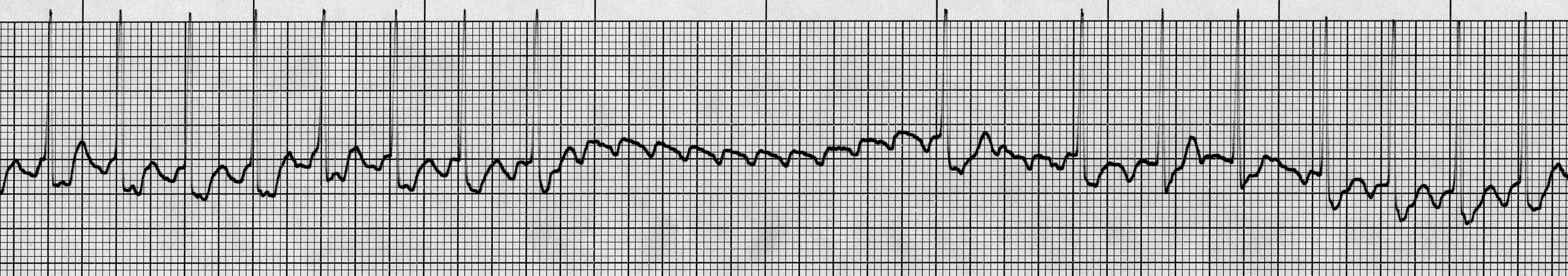 CSM inducing transient atrioventricular block