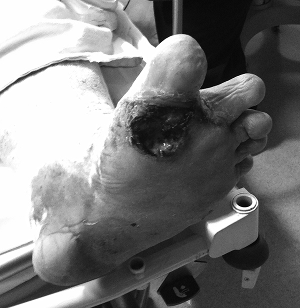 Diabetic foot ulcer