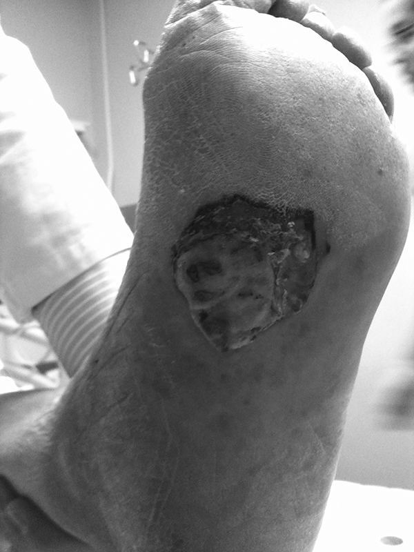 Ulcer with necrosis of skin