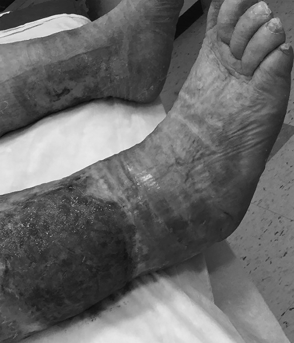 Venous stasis ulcer on lower leg