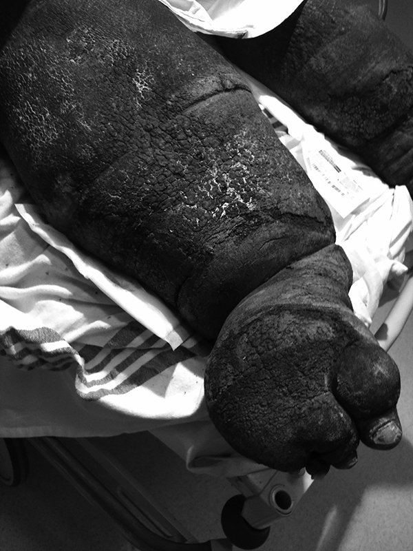 Severe venous stasis