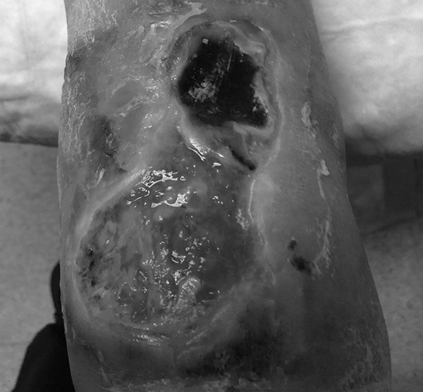 Venous ulcer with necrosis, exudate