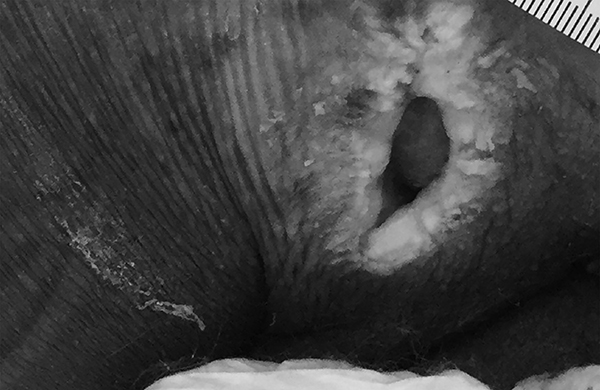 Ulcer with maceration, tunneling