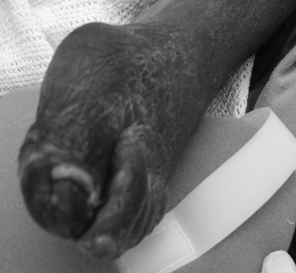 Arterial embolism causing necrosis