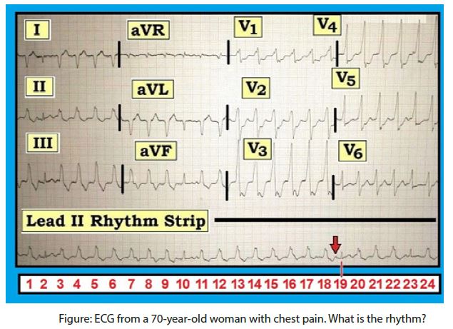 ECG
