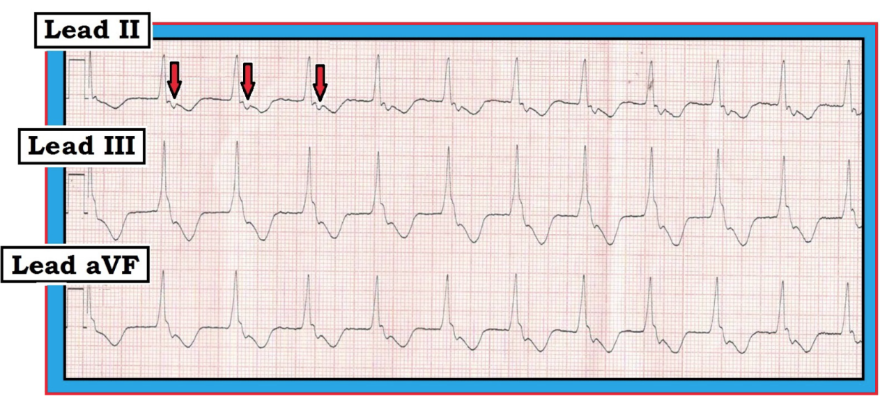 ECG Review