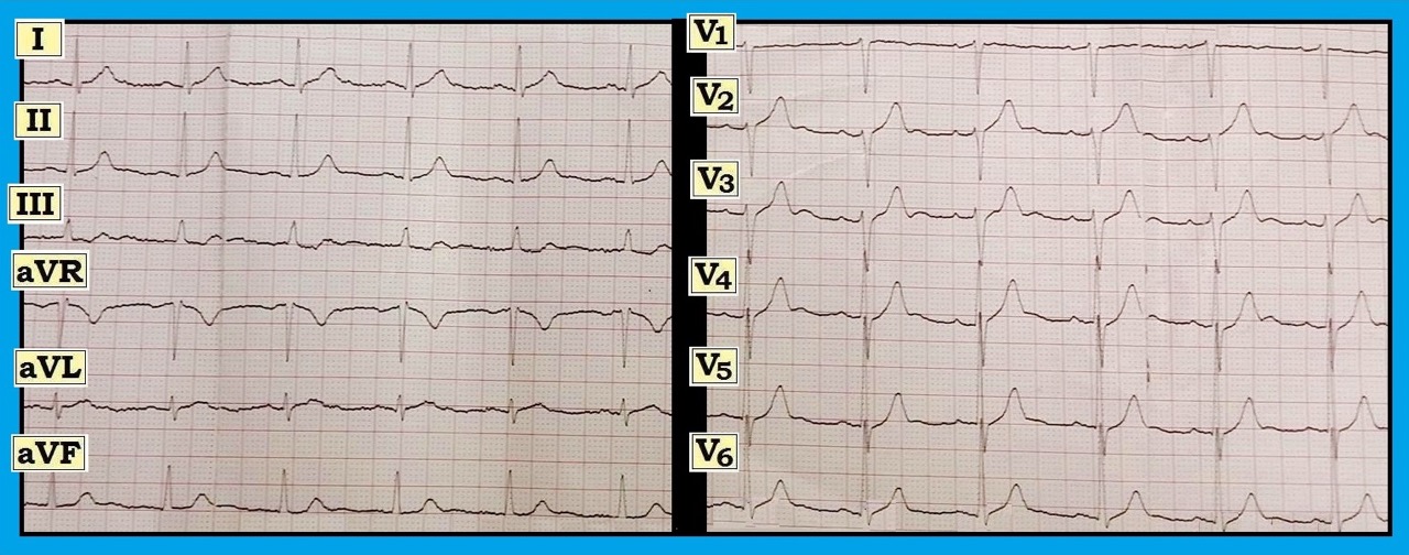 ECG Review 011516