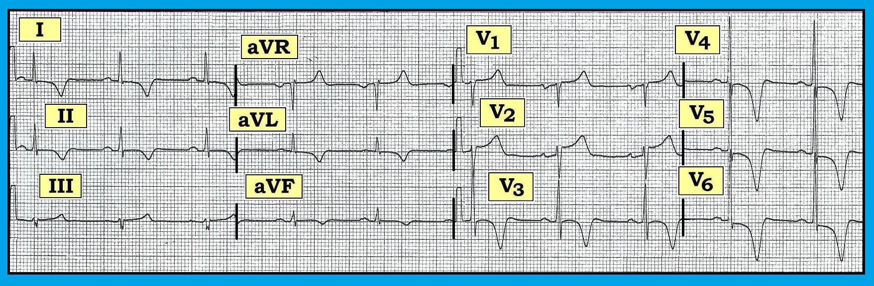 ECG Review