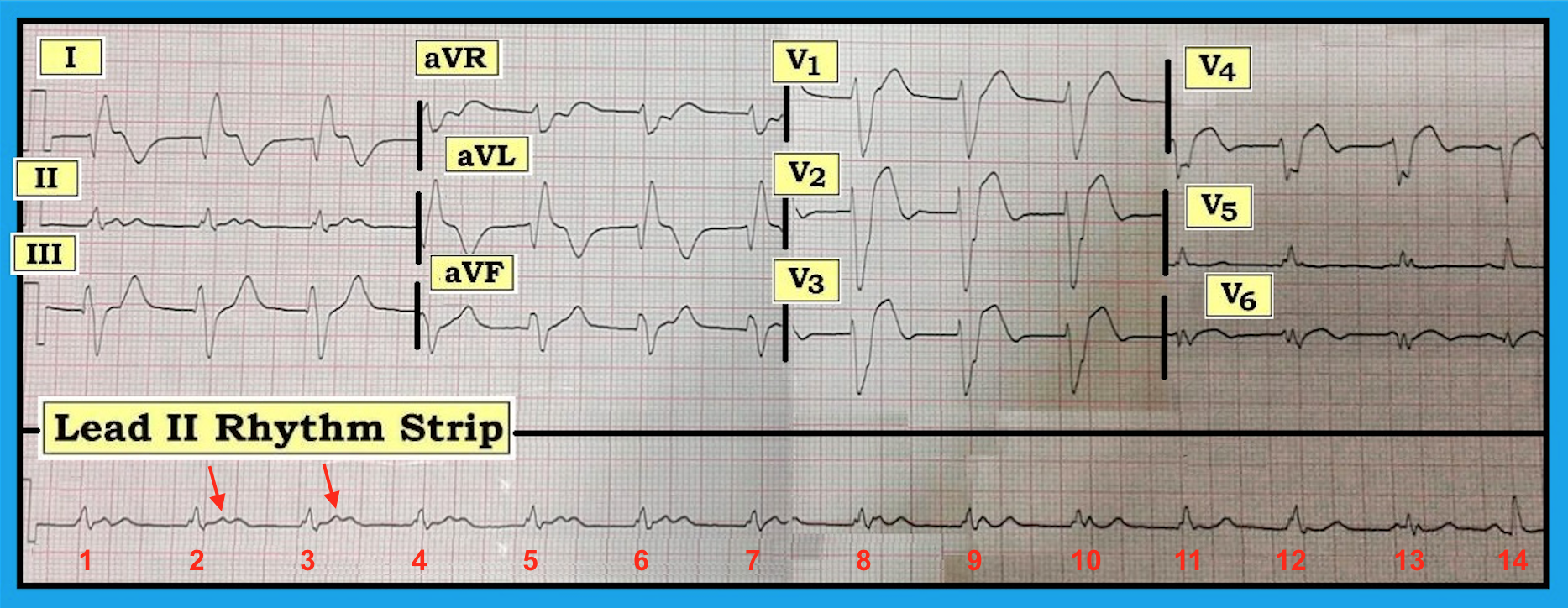 ECG Review Figure