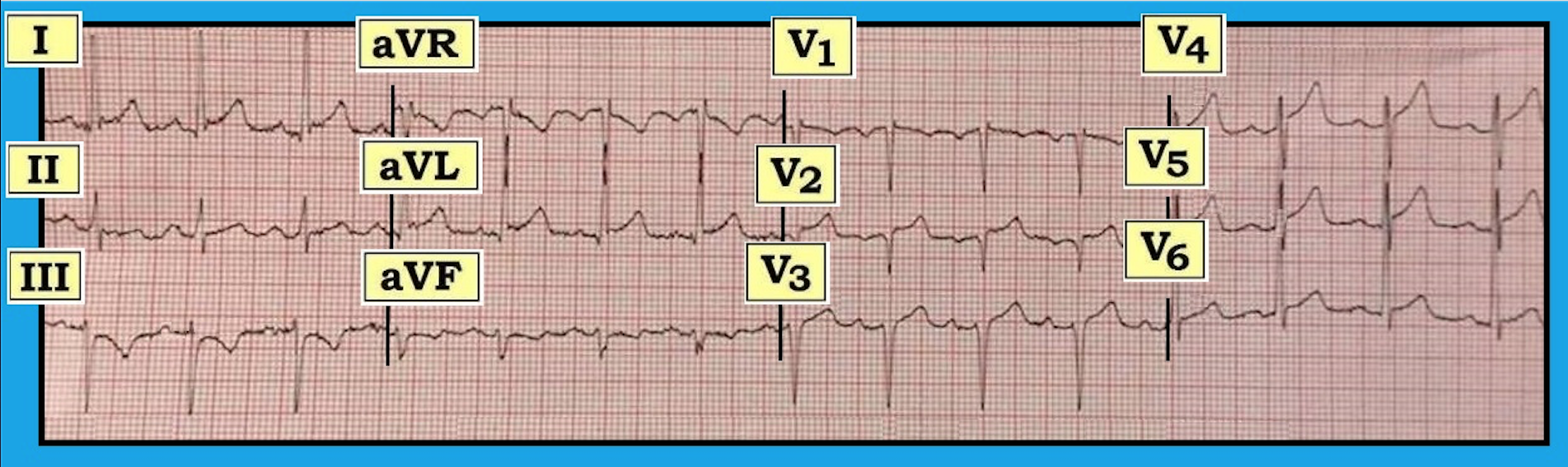 ECG Review 301